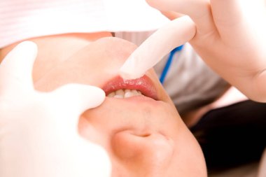 Hasta diş tedavisi görüyor, ağız bakımı görüyor.