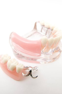 Öğrencilerin dişlerini gösteren eğitim modelini öğrenmeleri için implant ve ortodontik model