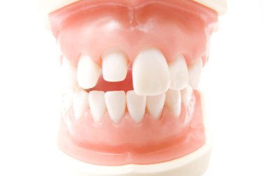 Öğrencilerin dişlerini gösteren eğitim modelini öğrenmeleri için implant ve ortodontik model