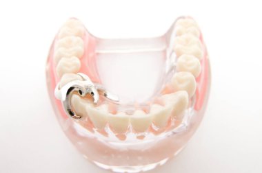 Öğrencilerin dişlerini gösteren eğitim modelini öğrenmeleri için implant ve ortodontik model