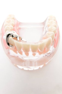Öğrencilerin dişlerini gösteren eğitim modelini öğrenmeleri için implant ve ortodontik model