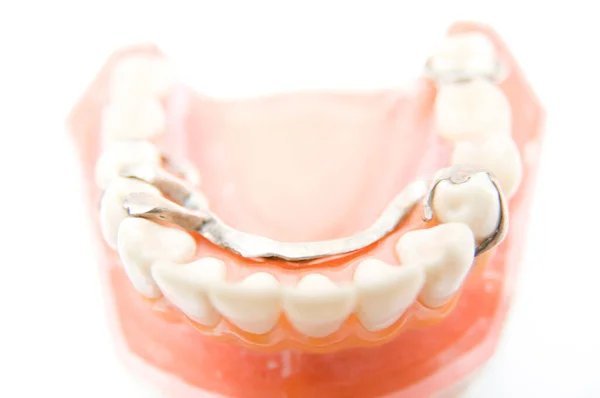 义齿种植体矫形外科教学模式与牙齿矫形外科教学模式 — 图库照片