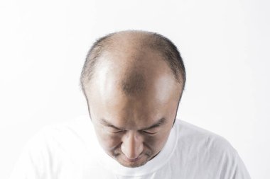 Adam saç temasını kaybediyor. Kafasında saç ve kellik lekesi var. Beyaz arkaplanda stüdyo görüntüsü 