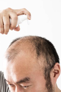 Adam saç temasını kaybediyor. Saç ve kellik lekesi olan bir erkek kafası. Beyaz arkaplanda stüdyo görüntüsü 