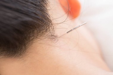 akupunktur oturumunu kapat 