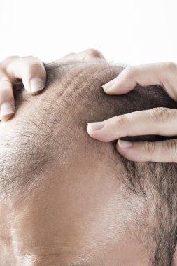 Adam saç temasını kaybediyor. Kafasında saç ve kellik lekesi var. Beyaz arkaplanda stüdyo görüntüsü 