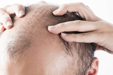 Adam saç temasını kaybediyor. Kafasında saç ve kellik lekesi var. Beyaz arkaplanda stüdyo görüntüsü 