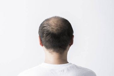 Adam saç temasını kaybediyor. Kafasında saç ve kellik lekesi var. Beyaz arkaplanda stüdyo görüntüsü 