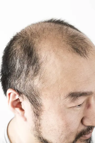 Homme Perdant Thème Des Cheveux Tête Masculine Avec Des Cheveux — Photo