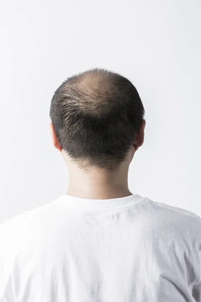 髪の毛のテーマを失った男 ソートヘアと脱毛スポットでヘッド ホワイトバックで撮影したスタジオ — ストック写真