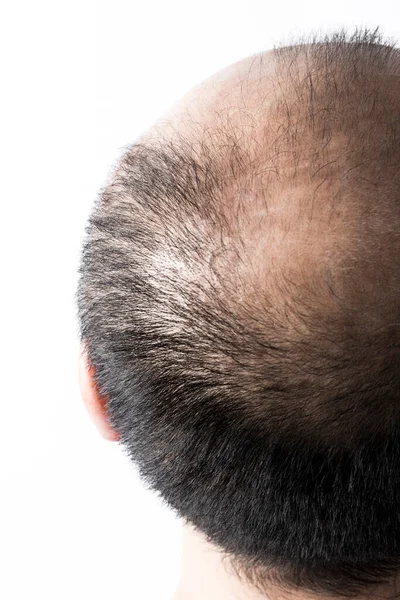 Мужчина Теряет Тему Волос Голова Прямыми Волосами Лысиной Студия Белом — стоковое фото