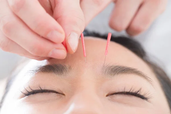 Belle Japonais Femme Obtention Acupuncture Traitement Dans Beauté Spa — Photo