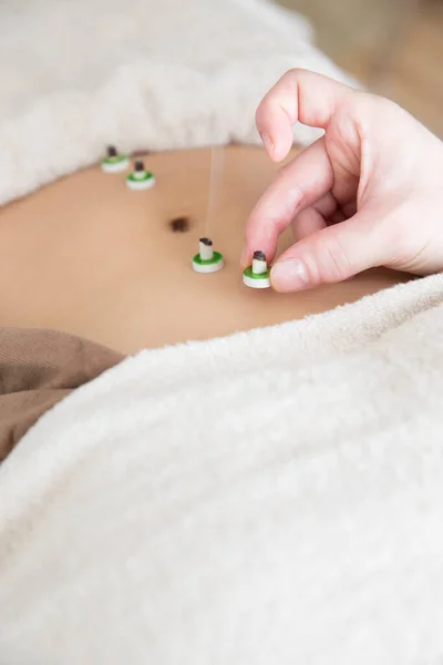 Beautiful Japanese Woman Getting Acupuncture Treatment In Beauty Spa
