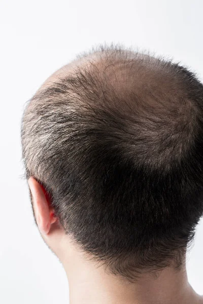 Άνθρωπος Χάνει Θέμα Των Μαλλιών Κεφάλι Τρίχες Και Φαλάκρα Στιγμιότυπο — Φωτογραφία Αρχείου