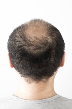 Adam saç temasını kaybediyor. Saç ve kellik lekesi olan bir erkek kafası. Beyaz arkaplanda stüdyo görüntüsü 