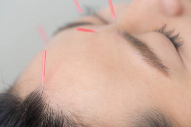 Güzel Japon Kadın Güzellik Merkezi 'nde Akupunktur Muayenesi Yapıyor