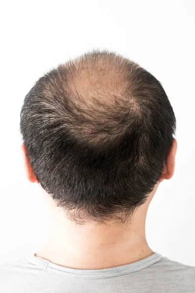 Άνθρωπος Χάνει Θέμα Των Μαλλιών Αρσενικό Κεφάλι Μαλλιά Και Φαλάκρα — Φωτογραφία Αρχείου