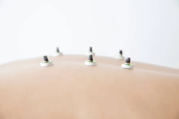 Piękna Japonka Coraz Leczenie Akupunktury Beauty Spa — Zdjęcie stockowe