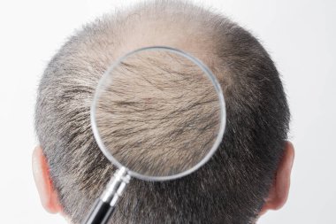 Adam saç temasını kaybediyor. Kafasında saç ve kellik lekesi var. Beyaz arkaplanda stüdyo görüntüsü 