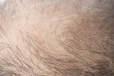 Adam saç temasını kaybediyor. Kafasında saç ve kellik lekesi var. Beyaz arkaplanda stüdyo görüntüsü 