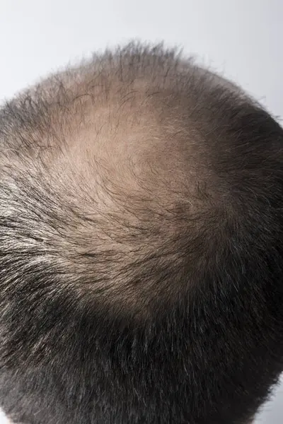 남자는 테마를 머리카락과 대머리 자리를 배경에 스튜디오 — 스톡 사진