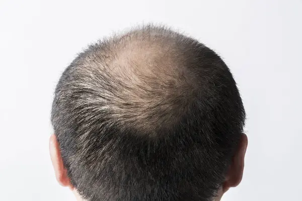 Мужчина Теряет Тему Волос Голова Прямыми Волосами Лысиной Студия Белом — стоковое фото