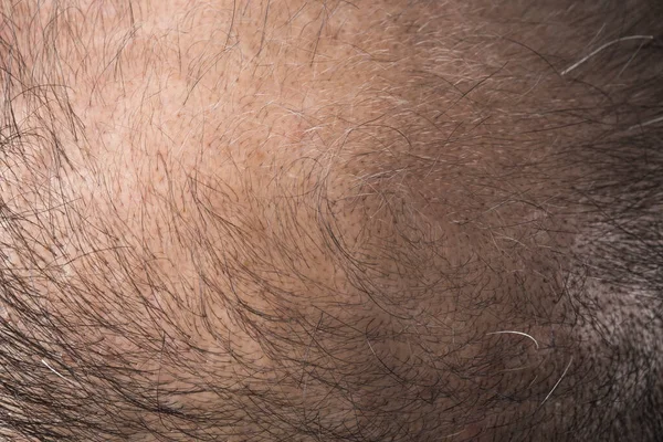 Adam Saç Temasını Kaybediyor Kafasında Saç Kellik Lekesi Var Beyaz — Stok fotoğraf