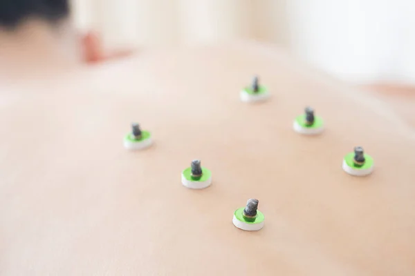 Piękna Japonka Coraz Leczenie Akupunktury Beauty Spa — Zdjęcie stockowe