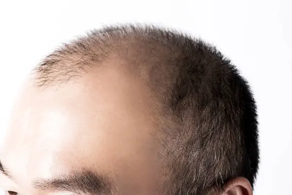 Homme Perdant Thème Des Cheveux Tête Avec Des Cheveux Tri — Photo