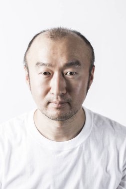 Adam saç temasını kaybediyor. Kafasında saç ve kellik lekesi var. Beyaz arkaplanda stüdyo görüntüsü 