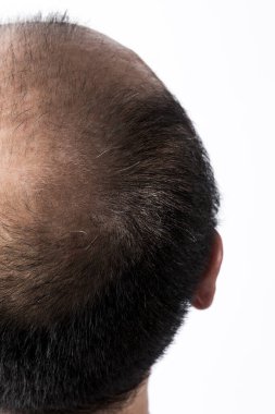 Adam saç temasını kaybediyor. Kafasında saç ve kellik lekesi var. Beyaz arkaplanda stüdyo görüntüsü 