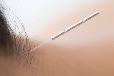 akupunktur oturumunu kapat 