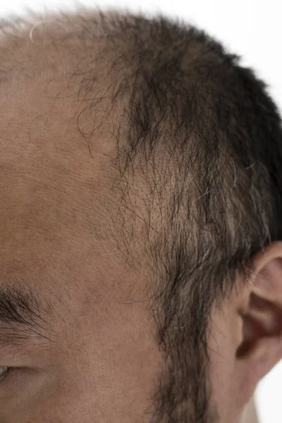 男人放松头发的主题 男人的头有一头秀发和秃顶的斑点 电影制片厂拍摄的白色背景 — 图库照片