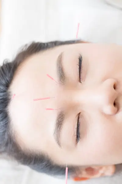 Mulher Japonesa Bonita Recebendo Tratamento Acupuntura Spa Beleza — Fotografia de Stock