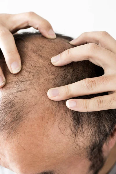 Άνθρωπος Χάνει Θέμα Των Μαλλιών Αρσενικό Κεφάλι Μαλλιά Και Φαλάκρα — Φωτογραφία Αρχείου