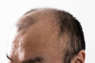 Adam saç temasını kaybediyor. Saç ve kellik lekesi olan bir erkek kafası. Beyaz arkaplanda stüdyo görüntüsü 