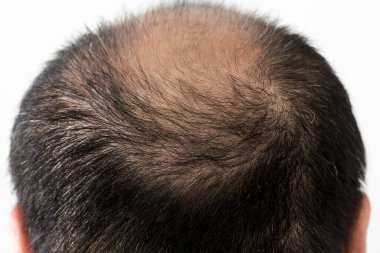 Adam saç temasını kaybediyor. Saç ve kellik lekesi olan bir erkek kafası. Beyaz arkaplanda stüdyo görüntüsü 