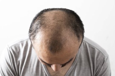 Adam saç temasını kaybediyor. Saç ve kellik lekesi olan bir erkek kafası. Beyaz arkaplanda stüdyo görüntüsü 