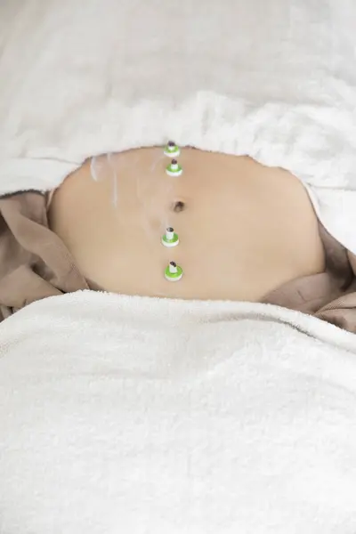 Schöne Japanerin Bekommt Akupunktur Behandlung Beauty Spa — Stockfoto