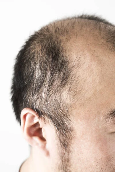 Homem Perdendo Cabelo Tema Cabeça Masculina Com Cabelo Tipo Calvície — Fotografia de Stock