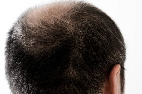 Adam Saç Temasını Kaybediyor Saç Kellik Lekesi Olan Bir Erkek — Stok fotoğraf