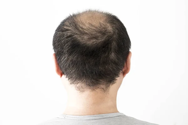 Mann Verliert Haare Thema Männerkopf Mit Sortiertem Haar Und Glatzenfleck — Stockfoto