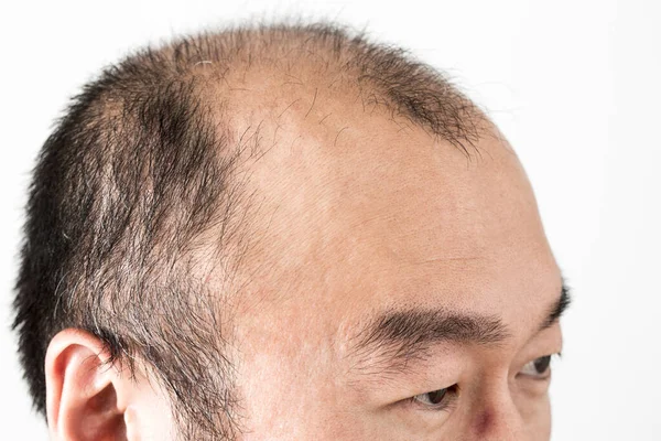 Homme Perdant Thème Des Cheveux Tête Masculine Avec Des Cheveux — Photo