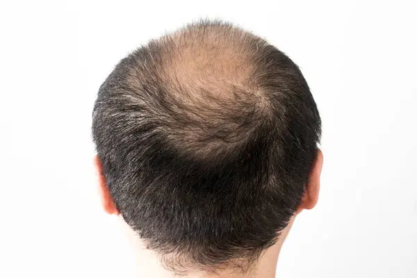 Чоловік Вивільняє Тему Волосся Чоловіча Голова Сортувальним Волоссям Плямою Облисіння — стокове фото
