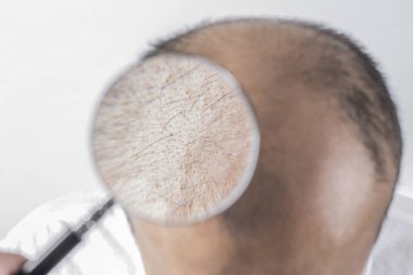 Adam saç temasını kaybediyor. Kafasında saç ve kellik lekesi var. Beyaz arkaplanda stüdyo görüntüsü 