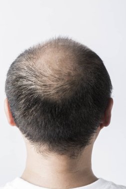 Adam saç temasını kaybediyor. Kafasında saç ve kellik lekesi var. Beyaz arkaplanda stüdyo görüntüsü 