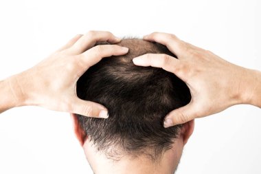 Adam saç temasını kaybediyor. Saç ve kellik lekesi olan bir erkek kafası. Beyaz arkaplanda stüdyo görüntüsü 