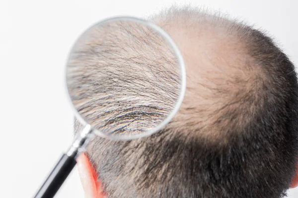 Man Loosing Hair Theme Head Sort Hair Baldness Spot Studio — Stock Photo, Image