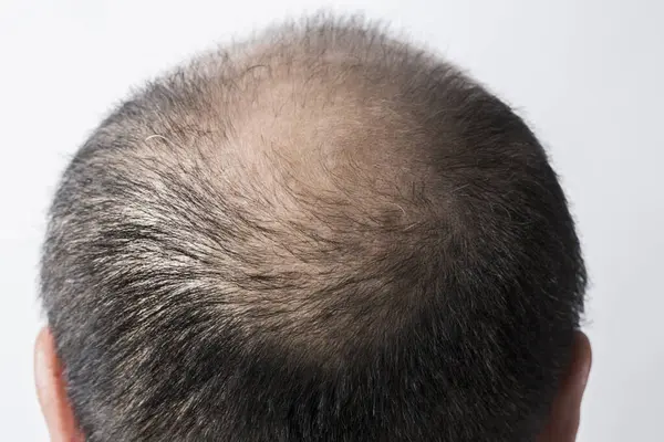 Adam Saç Temasını Kaybediyor Kafasında Saç Kellik Lekesi Var Beyaz — Stok fotoğraf