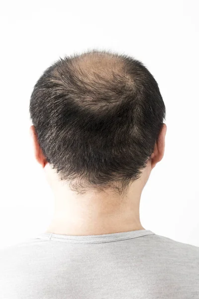 髪の毛のテーマを失った男 ソートヘアと脱毛スポットを持つ男性の頭部 ホワイトバックで撮影したスタジオ — ストック写真